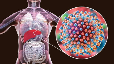 Sólo cinco de cada cien personas con hepatitis C accederán a la cura en Argentina