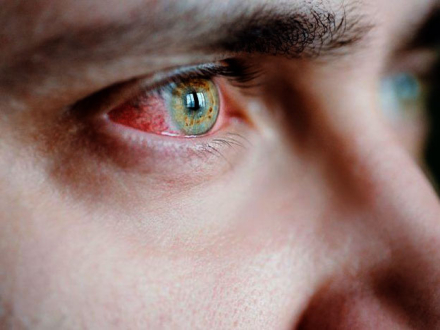 infeccion-ojos.jpg
