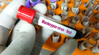 La OMS registra más de 50 mil casos de viruela del mono en el mundo