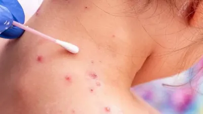La OMS aseguró que la viruela del mono ya no es una emergencia sanitaria global