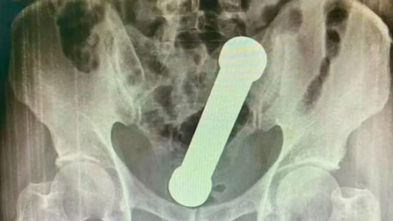 Le extrajeron un objeto del cuerpo luego de participar en un peligroso juego sexual