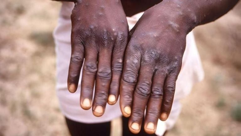 mpox3.jpg