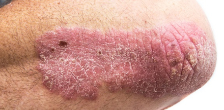 psoriasis2.jpg