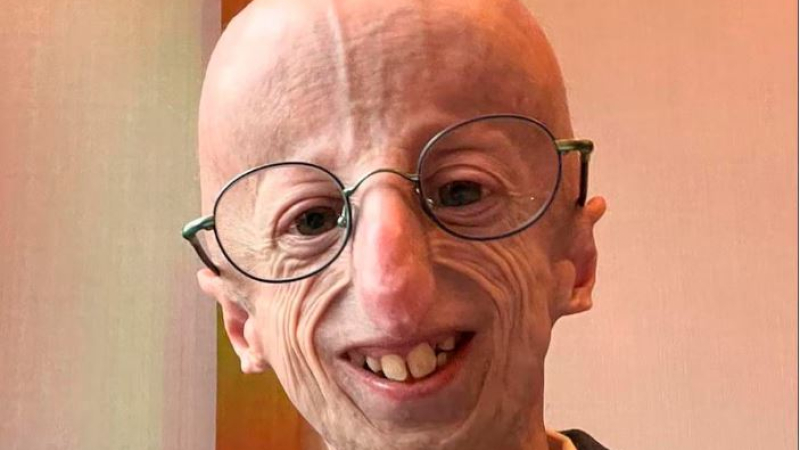 Murió Sammy Basso, el italiano que visibilizó el síndrome de progeria que lo envejecía prematuramente