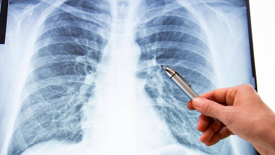 El virus sincicial respiratorio puede ser derrotado con prevención