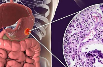 El cáncer de estómago y su alianza con el sistema nervioso
