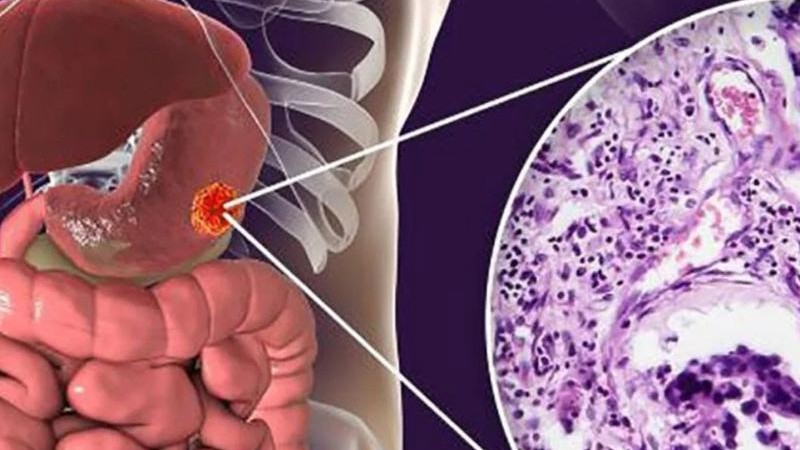 El cáncer de estómago y su alianza con el sistema nervioso