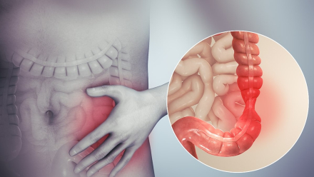 Irritable_bowel_syndrome.jpg