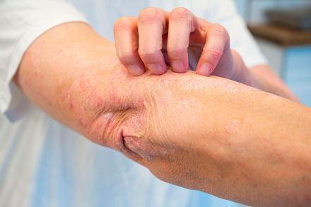 psoriasis