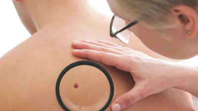 Aumentan los casos de cáncer de piel en la región