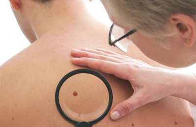 Aumentan los casos de cáncer de piel en la región