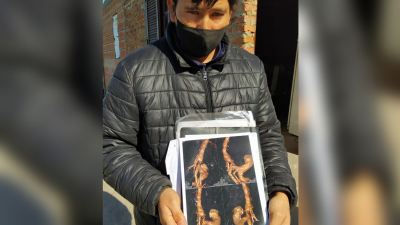 Mauricio tiene coartación aórtica y su vida pende de un hilo
