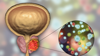 Mes de Concientización del Cáncer de Vejiga: se detectan alrededor de 10 nuevos casos por día