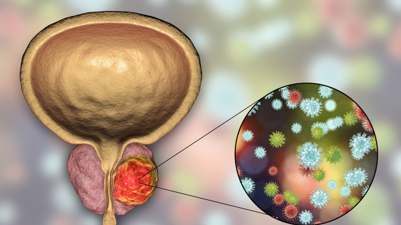 Mes de Concientización del Cáncer de Vejiga: se detectan alrededor de 10 nuevos casos por día
