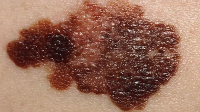 La importancia de detectar los signos y los síntomas del melanoma