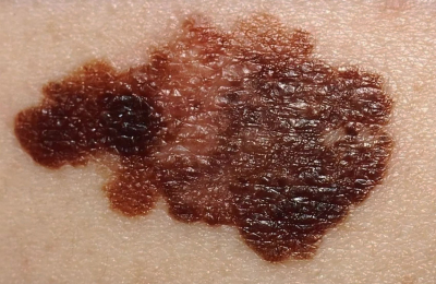 La importancia de detectar los signos y los síntomas del melanoma