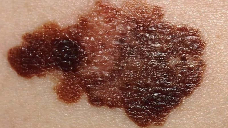 La importancia de detectar los signos y los síntomas del melanoma