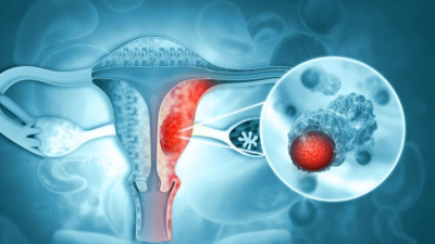 Cáncer de ovario: en el 80% de los casos se diagnostica cuando ya está avanzado