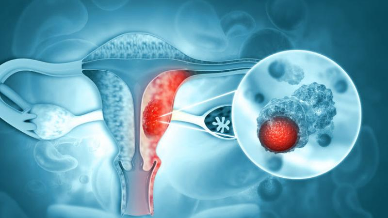 Cáncer de ovario: en el 80% de los casos se diagnostica cuando ya está avanzado