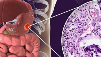 El cáncer de estómago y su alianza con el sistema nervioso