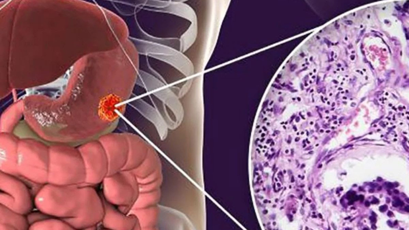 El cáncer de estómago y su alianza con el sistema nervioso