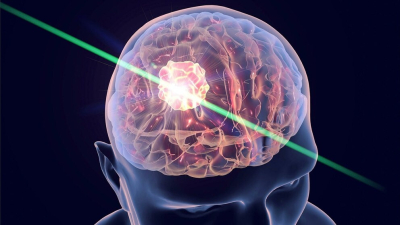 Una "linterna molecular" para detectar metástasis cerebrales