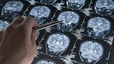 China pone freno a las cirugías en el tratamiento del Alzheimer