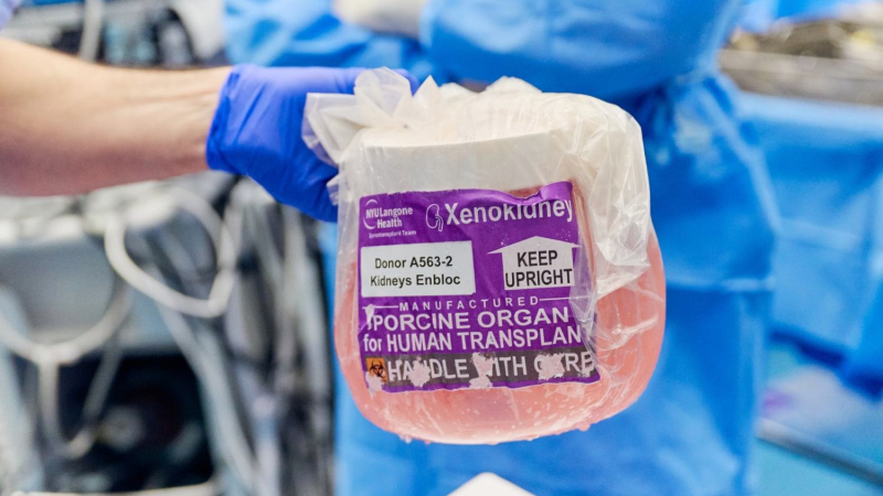 Primer xenotrasplante de hígado porcino en paciente vivo