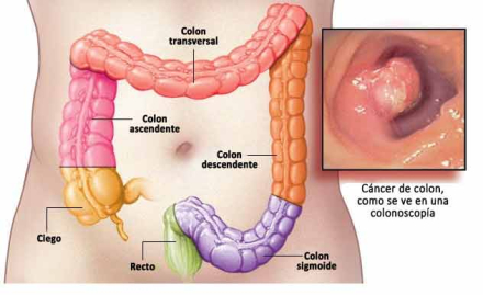 cáncer-colorrectal.jpg
