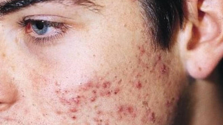 acne.jpg