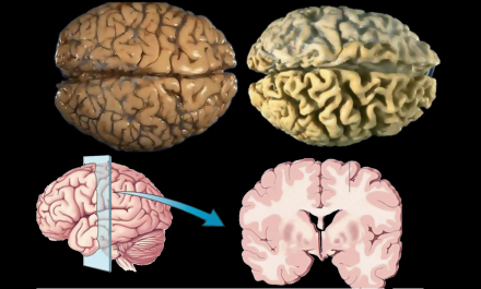 envejecimiento cerebral 1.jpg