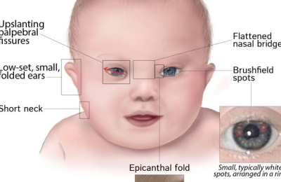 Resuelven "misterio" de cardiopatías congénitas en síndrome de Down