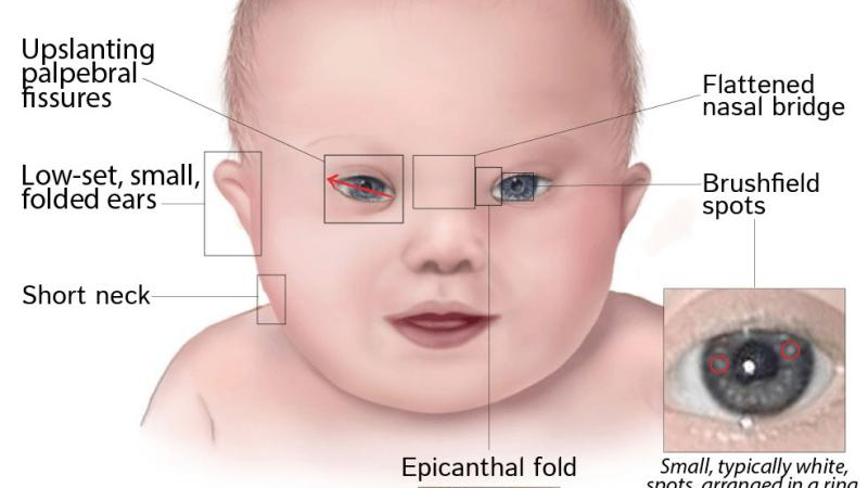 Resuelven "misterio" de cardiopatías congénitas en síndrome de Down
