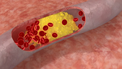 El colesterol amplifica el riesgo cardiovascular en pacientes con diabetes