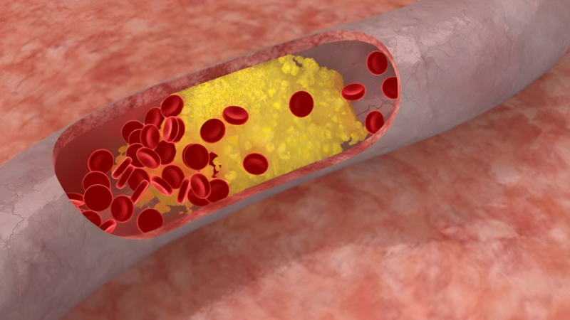El colesterol amplifica el riesgo cardiovascular en pacientes con diabetes