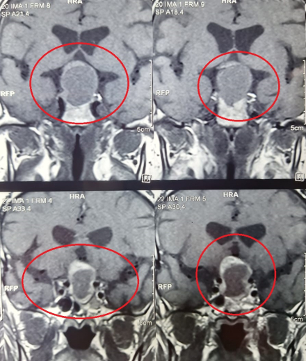 Neurocirugía y Otorrino HAC (1)