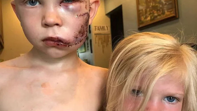 Pequeño superhéroe real: salvó a su hermana del ataque de un perro, y le costó 90 puntos de sutura