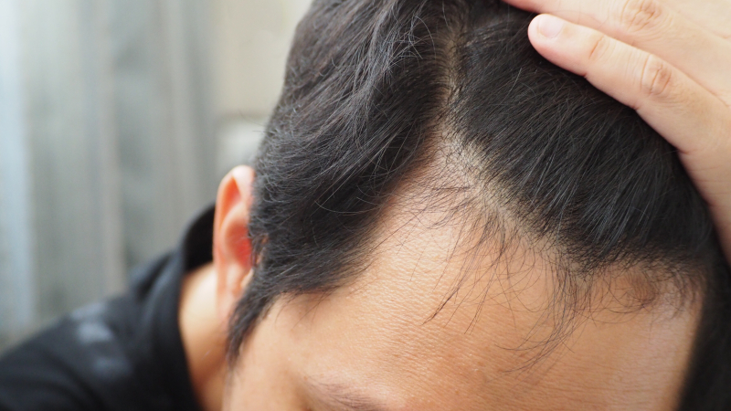 ¿Te recomendaron un medicamento casero para frenar la caída del pelo?: conocé los pasos a seguir para solucionar el problema de verdad