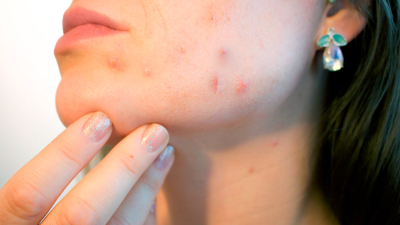Viruela del mono: confirmaron los dos primeros casos positivos de la enfermedad en el país