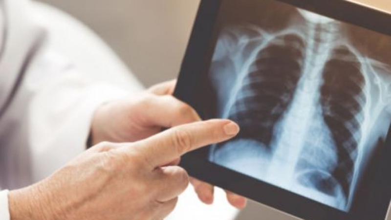 Qué es la Legionella, la enfermedad que estaría detrás de las muertes por neumonía en Tucumán