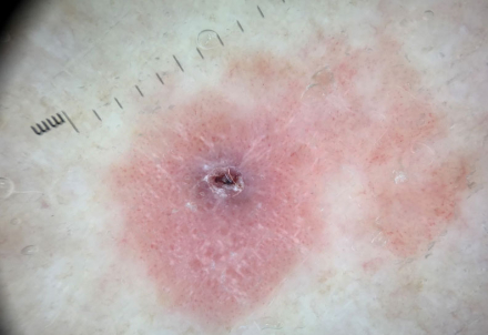 melanoma2.jpg