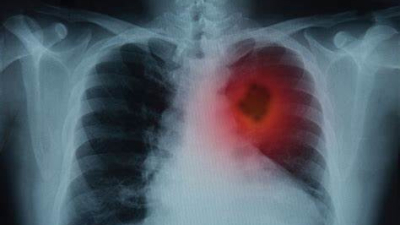 Argentina aprobó el uso de un tratamiento para el cáncer de pulmón