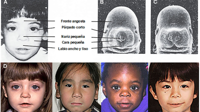 Síndrome alcohólico fetal, discapacidad más frecuente de lo que se piensa