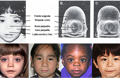 Síndrome alcohólico fetal, discapacidad más frecuente de lo que se piensa