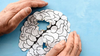 Un nuevo fármaco contra el alzhéimer muestra eficacia en la reducción de placas amiloides e inflamación cerebral  
