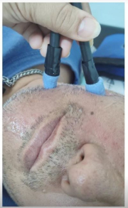 Recuperación Parálisis facial.jpg