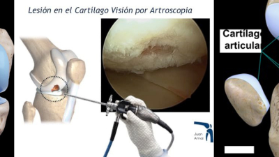 Desarrollo de científicos argentinos permitirá regenerar articulaciones con células propias